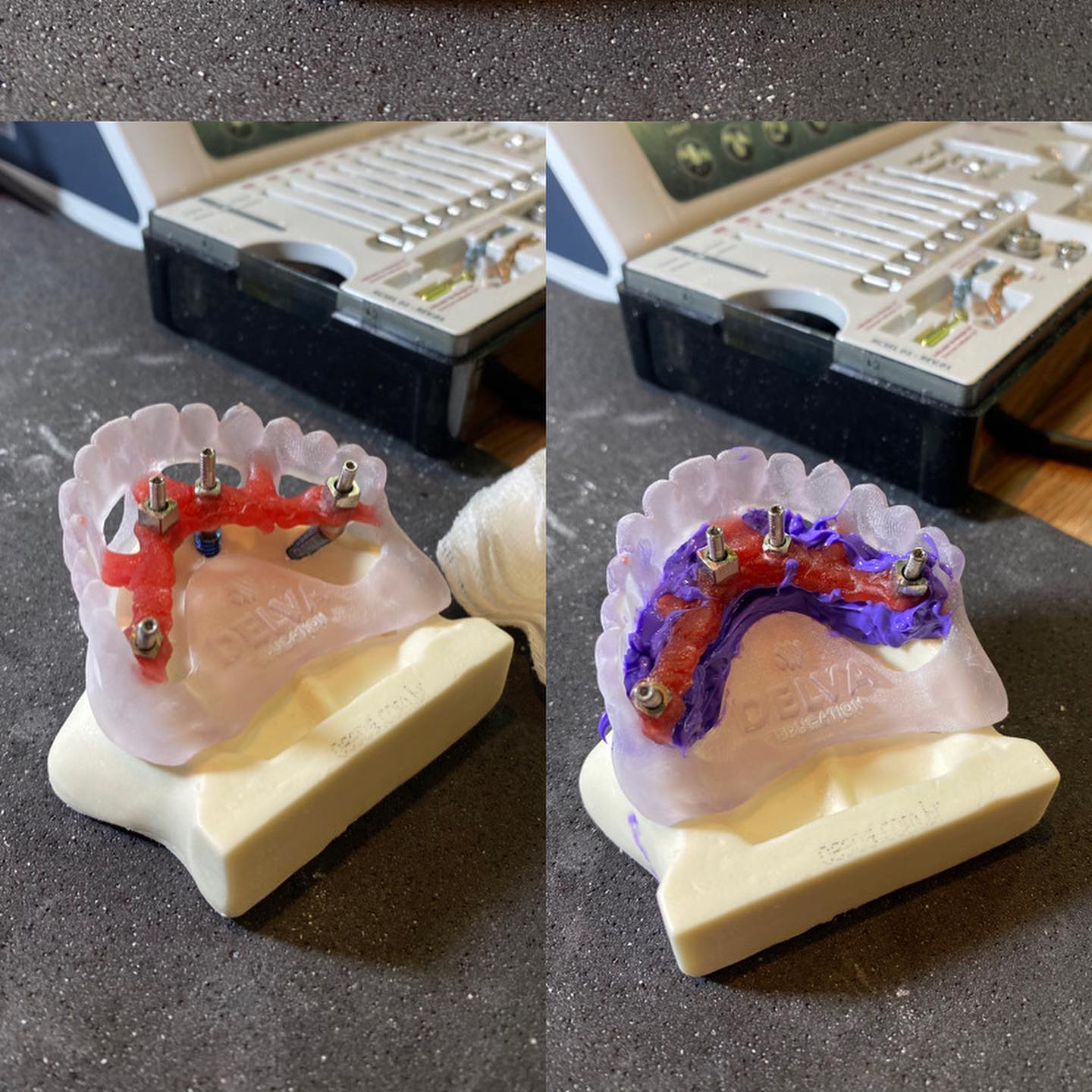 Modelos de implantes dentários